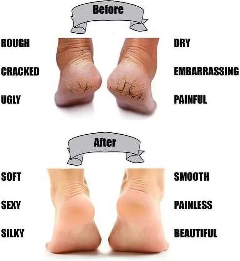 Anti - Crack Heels Pain Relief image